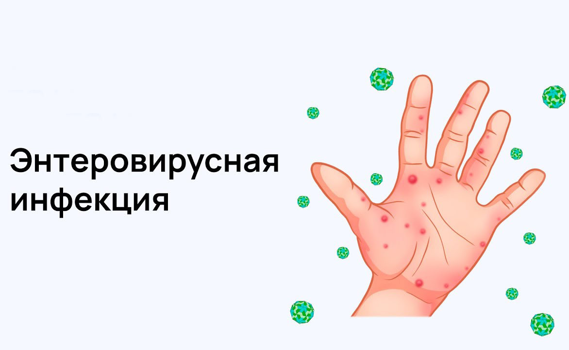 Энтеровирусная инфекция у детей Энтеровирусная инфекция у детей